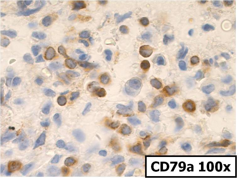 CD79a 100x, Smaller blasts are positive for CD79a